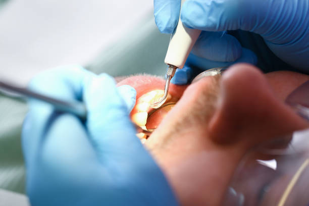 Best Emergency Tooth Extraction in Little Elm, TX