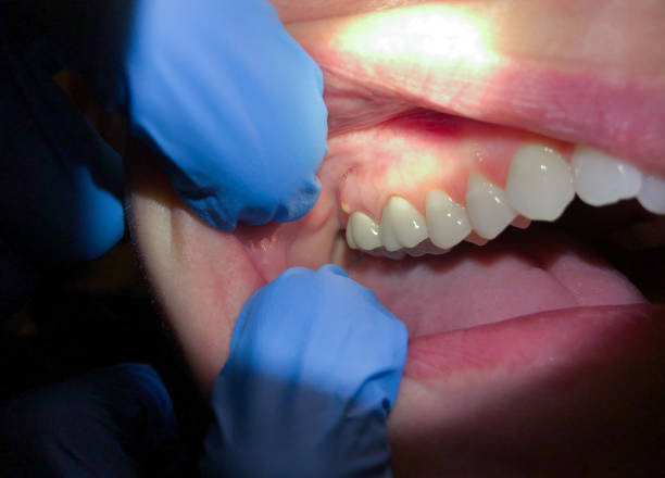 Best Emergency Broken Tooth Repair in Little Elm, TX
